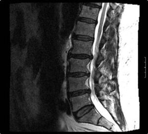rentgenski pregled vratne hrbtenice z osteohondrozo