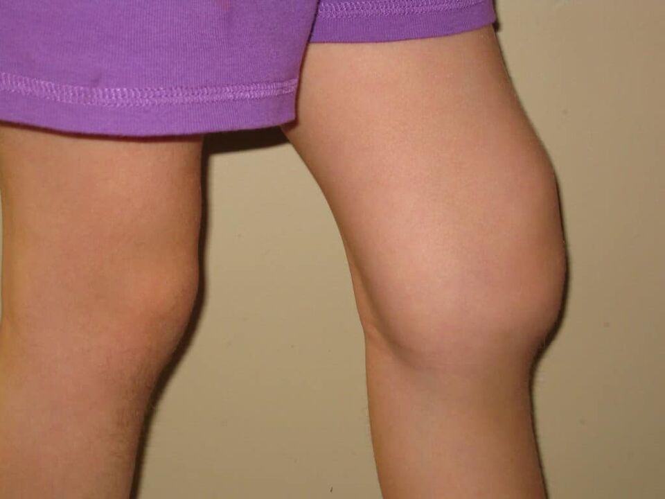 Patologija kolena z napredovalo artrozo