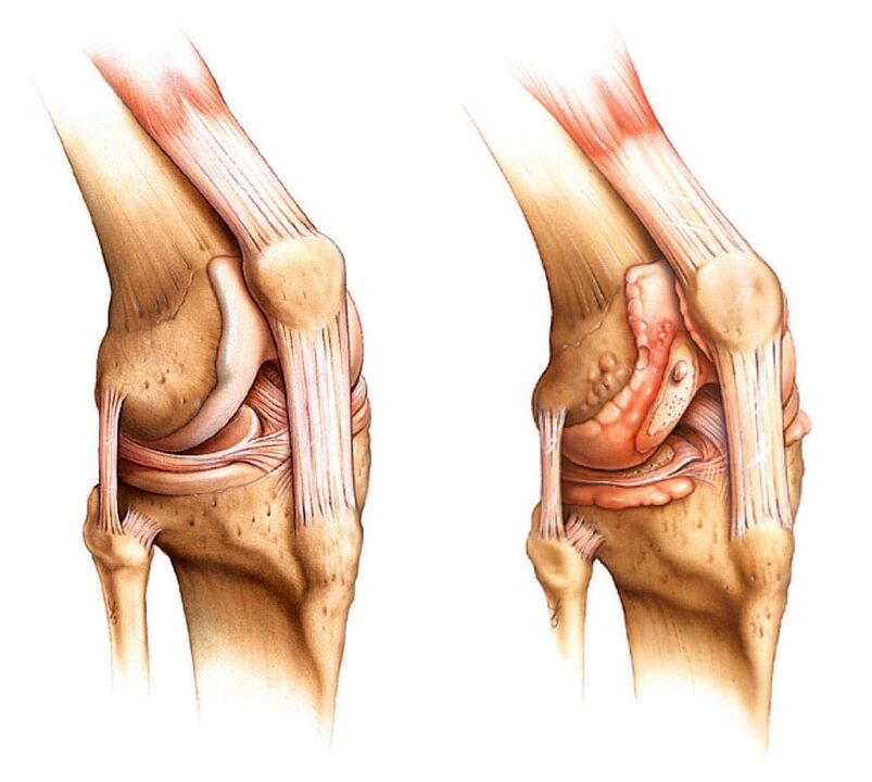 Zdrav sklep (levo) in artritičen sklep (desno)