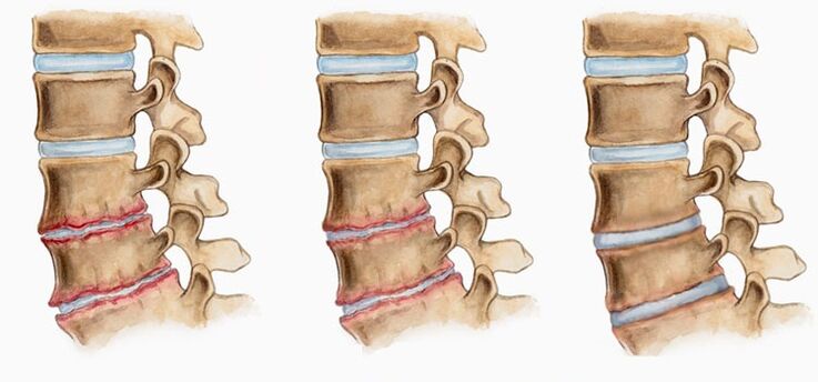 Deformacija medvretenčnih ploščic pri osteohondrozi lahko povzroči bolečine v hrbtu