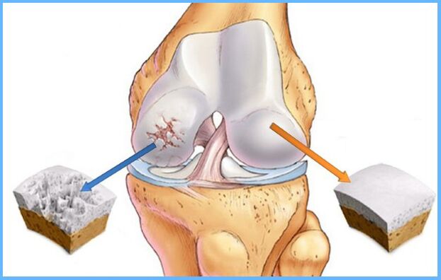 Arthroza kolenskega sklepa