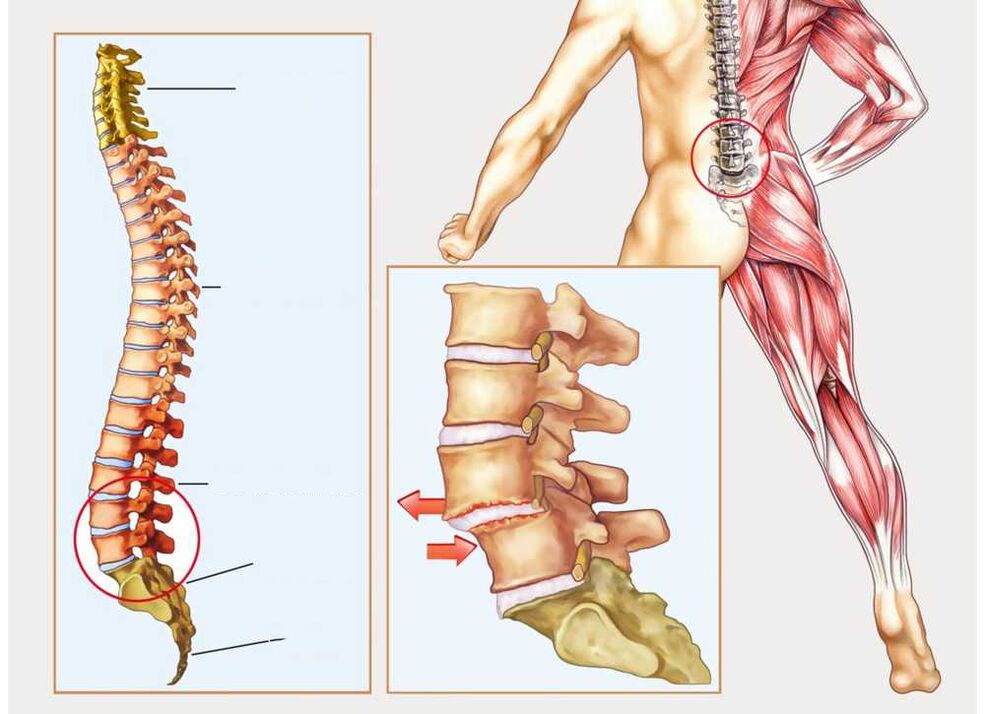 zdravo in bolno hrbtenico