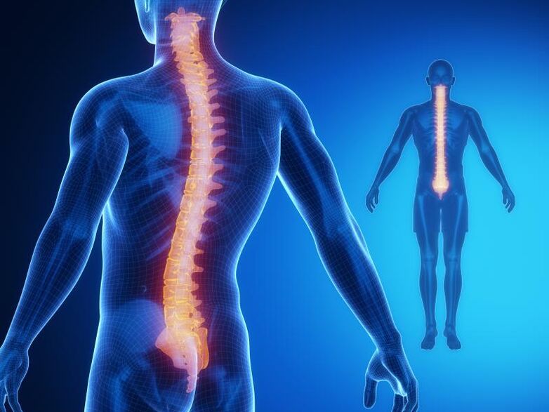 Osteohondroza hrbtenice, ki zahteva kompleksno zdravljenje