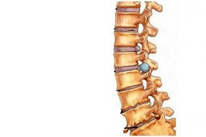 spremembe na hrbtenici v različnih fazah razvoja cervikalne osteohondroze