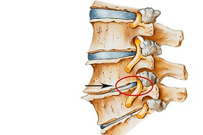 stisnjen disk hrbtenice kot vzrok za cervikalno osteohondrozo