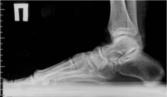 Arthroza prstov in stopal