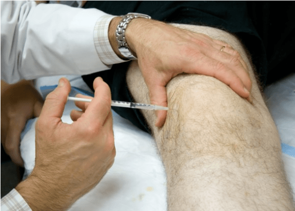 Intra -artikularno dajanje analgetikov pri hudi bolečini