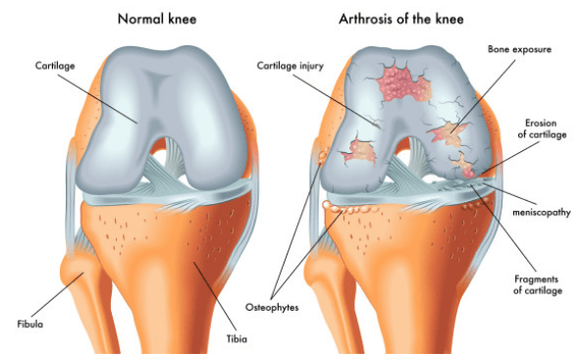Normalni sklep in prizadet arthroza